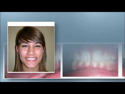 Impacted Tooth Procedure