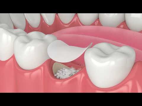 Dental Bone Grafting Procedure