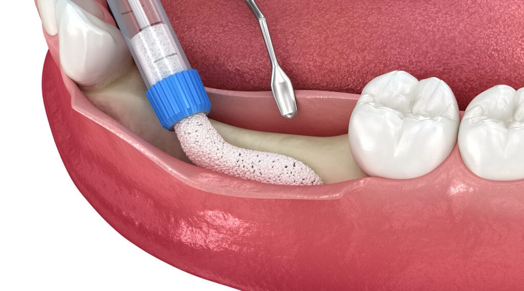 Alveoplasty Alveoplasty