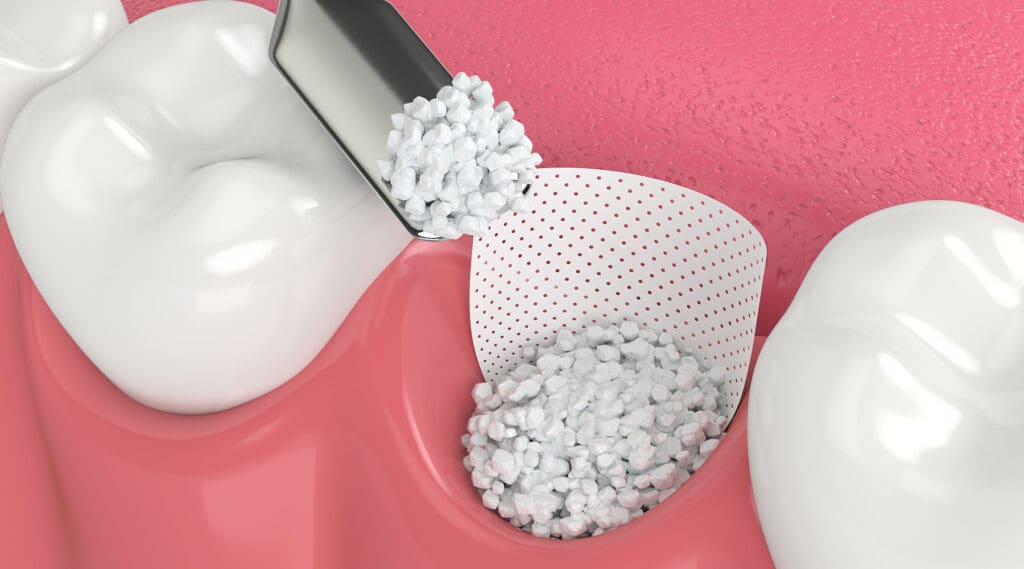 Bone Graft Bone Graft