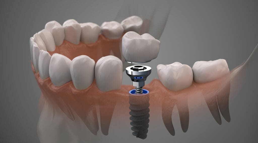 Dental Implants