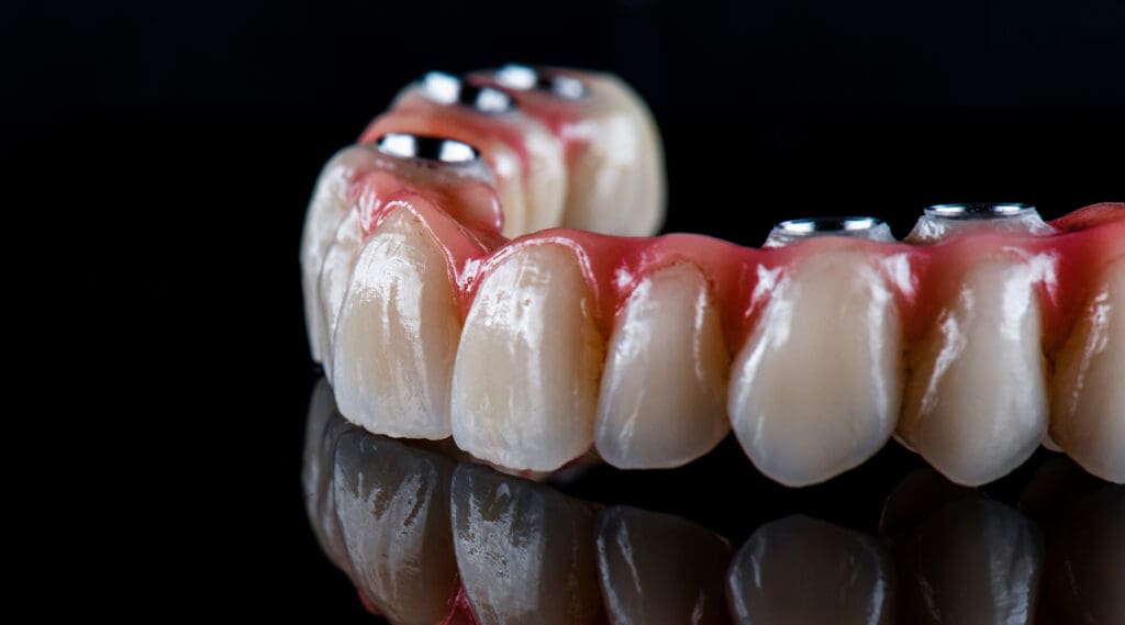 Full Mouth Dental Implants