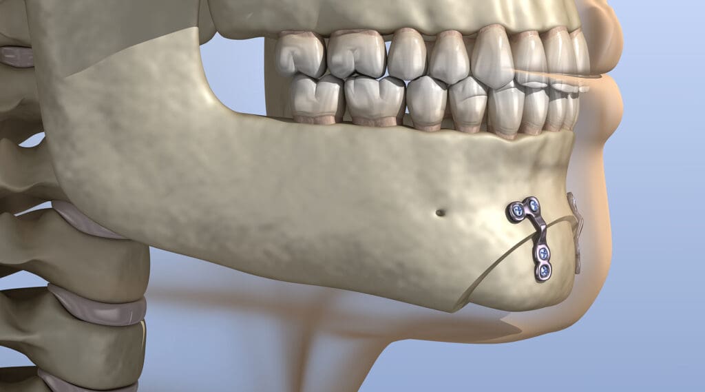 Genioplasty Genioplasty