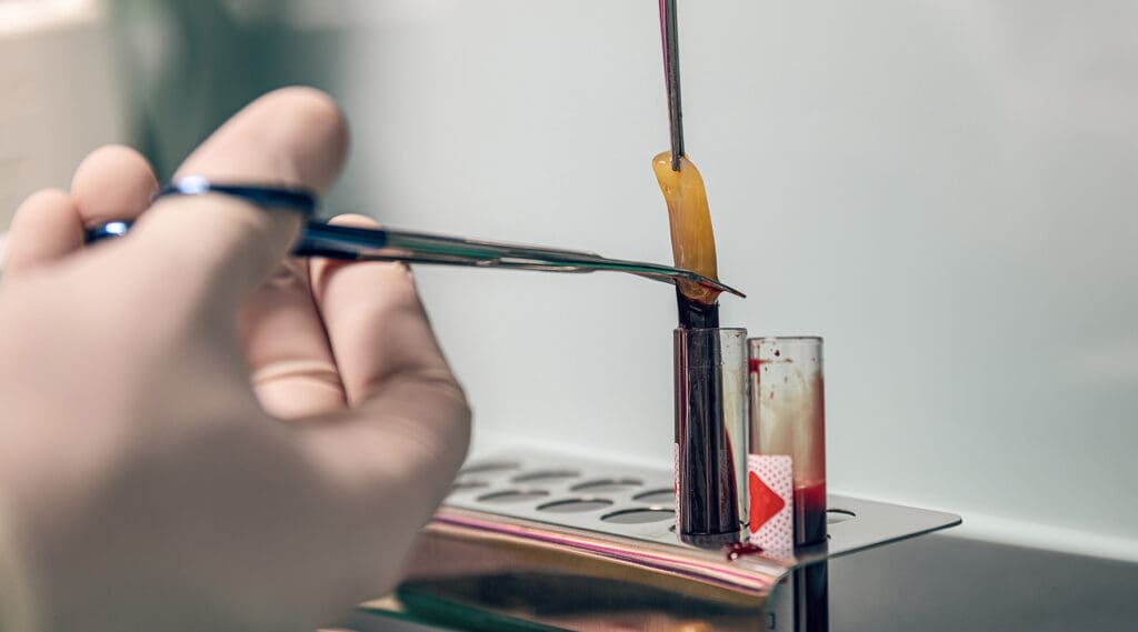 Platelet Rich Fibrin Platelet Rich Fibrin