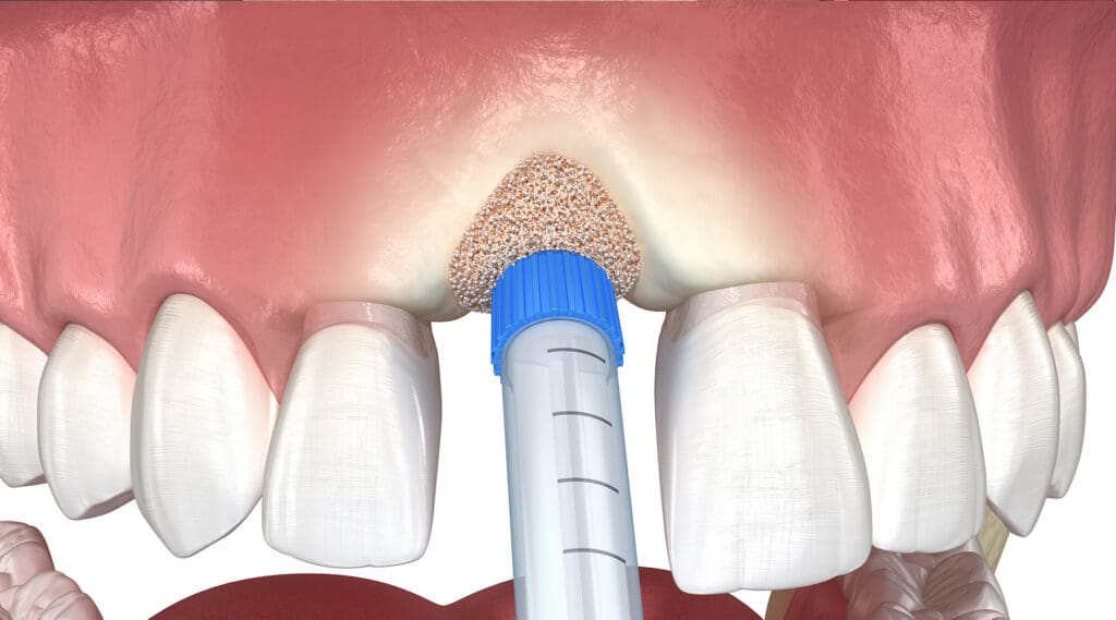 Socket Preservation Socket Preservation