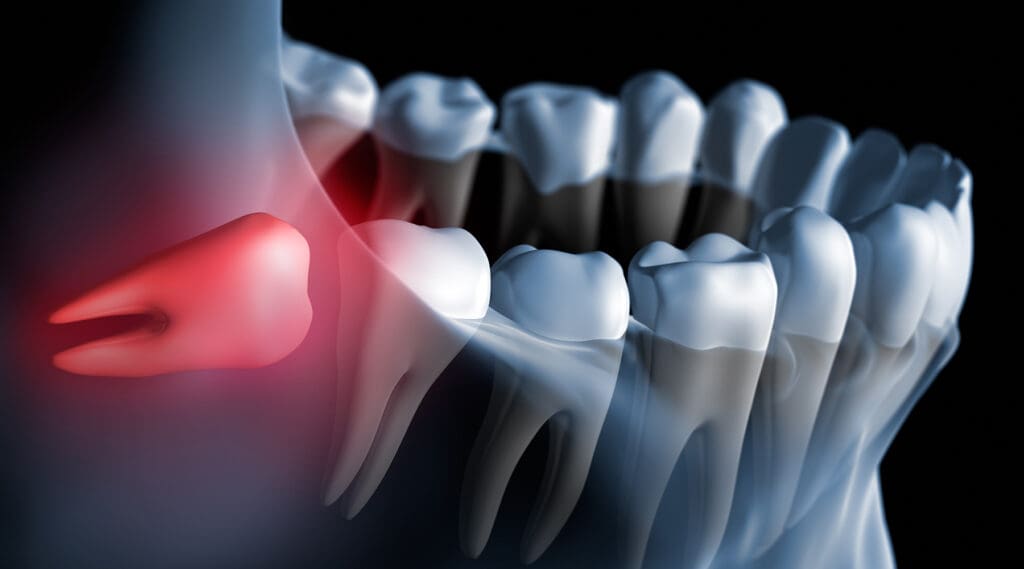 Wisdom Teeth Removal Wisdom Teeth Removal