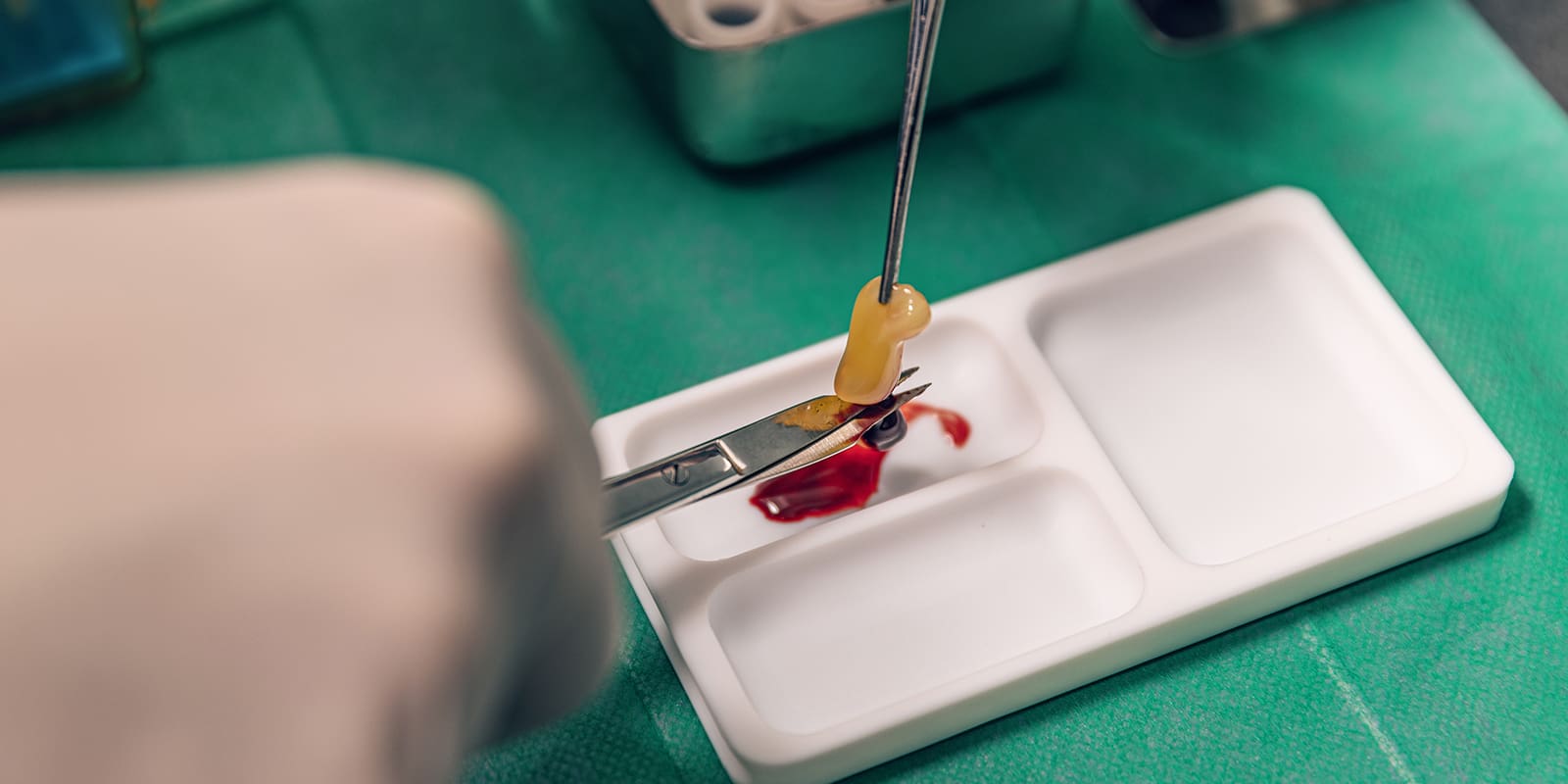 Experience Faster Healing and Less Pain With Platelet-Rich Fibrin