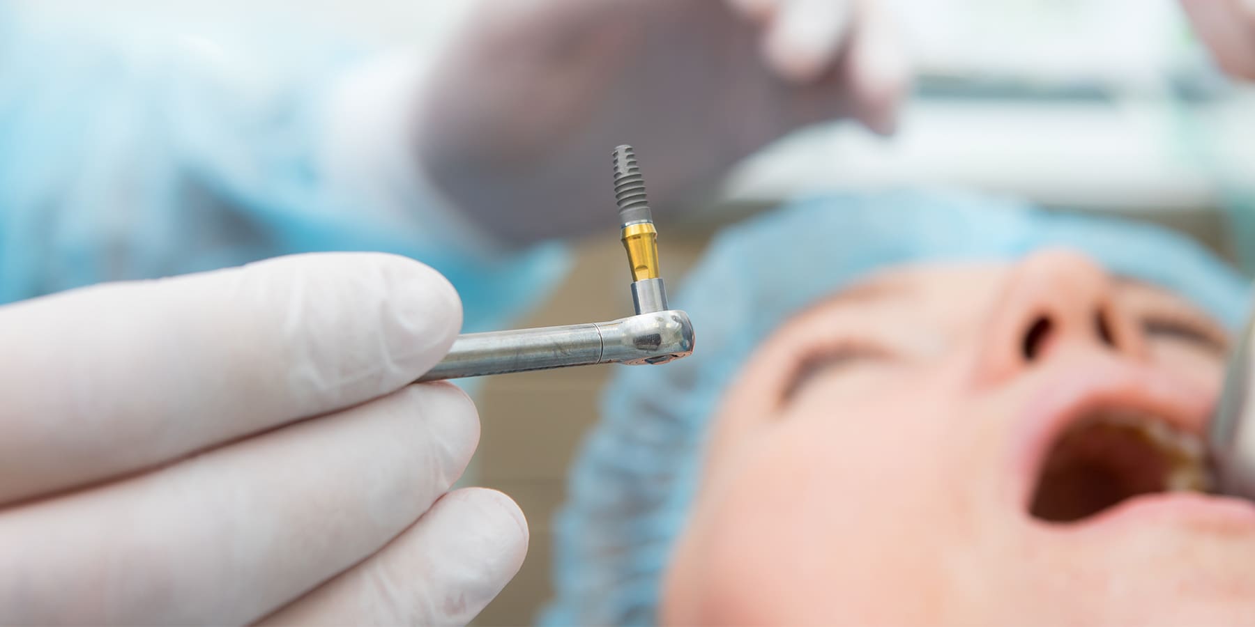 Dental Implant Timeline: What to Expect from Start to Finish