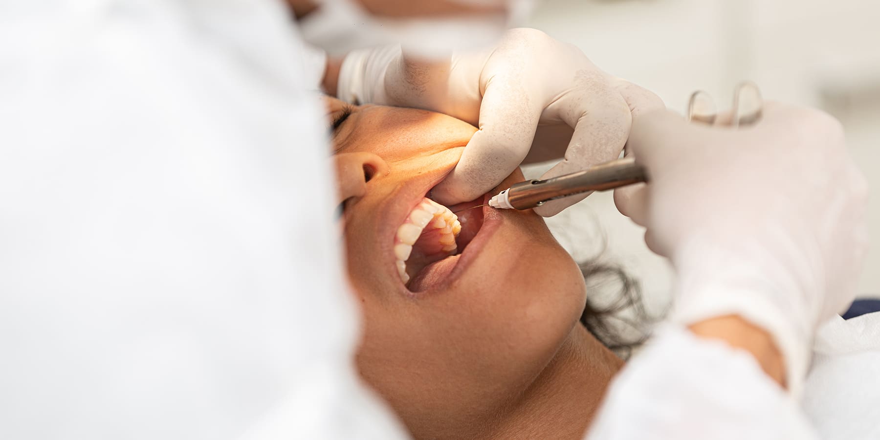 Wisdom Teeth Extraction and PRF: A Faster, Better Recovery