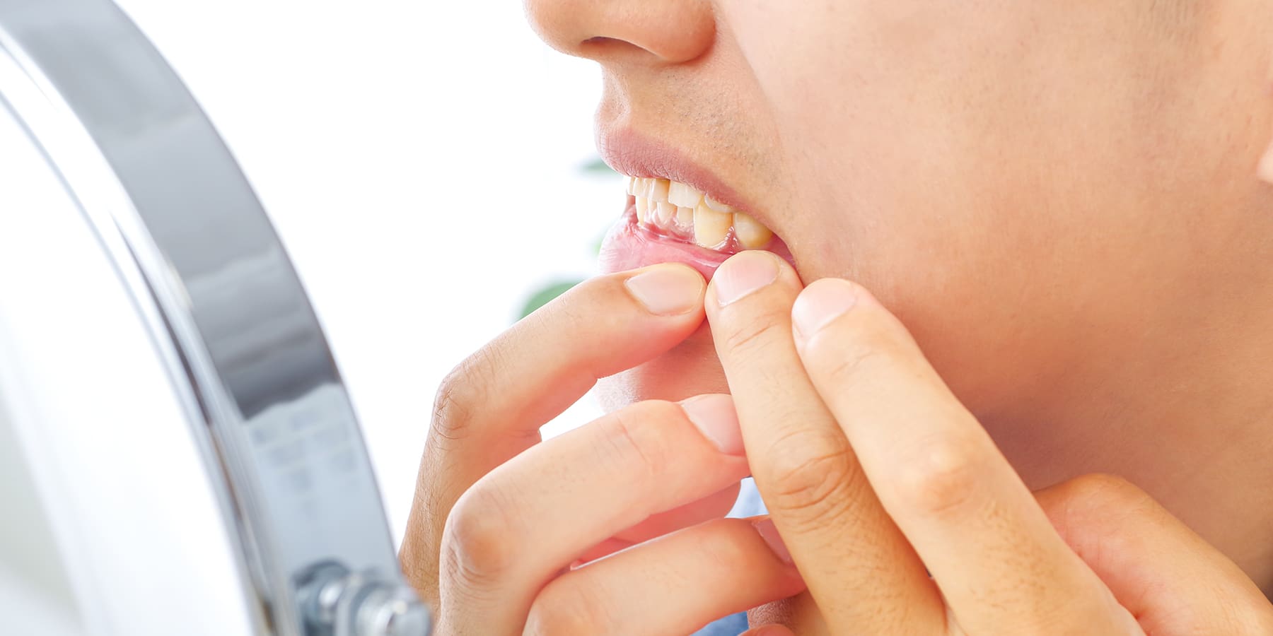 How Long Do Wisdom Teeth Stitches Take to Dissolve?