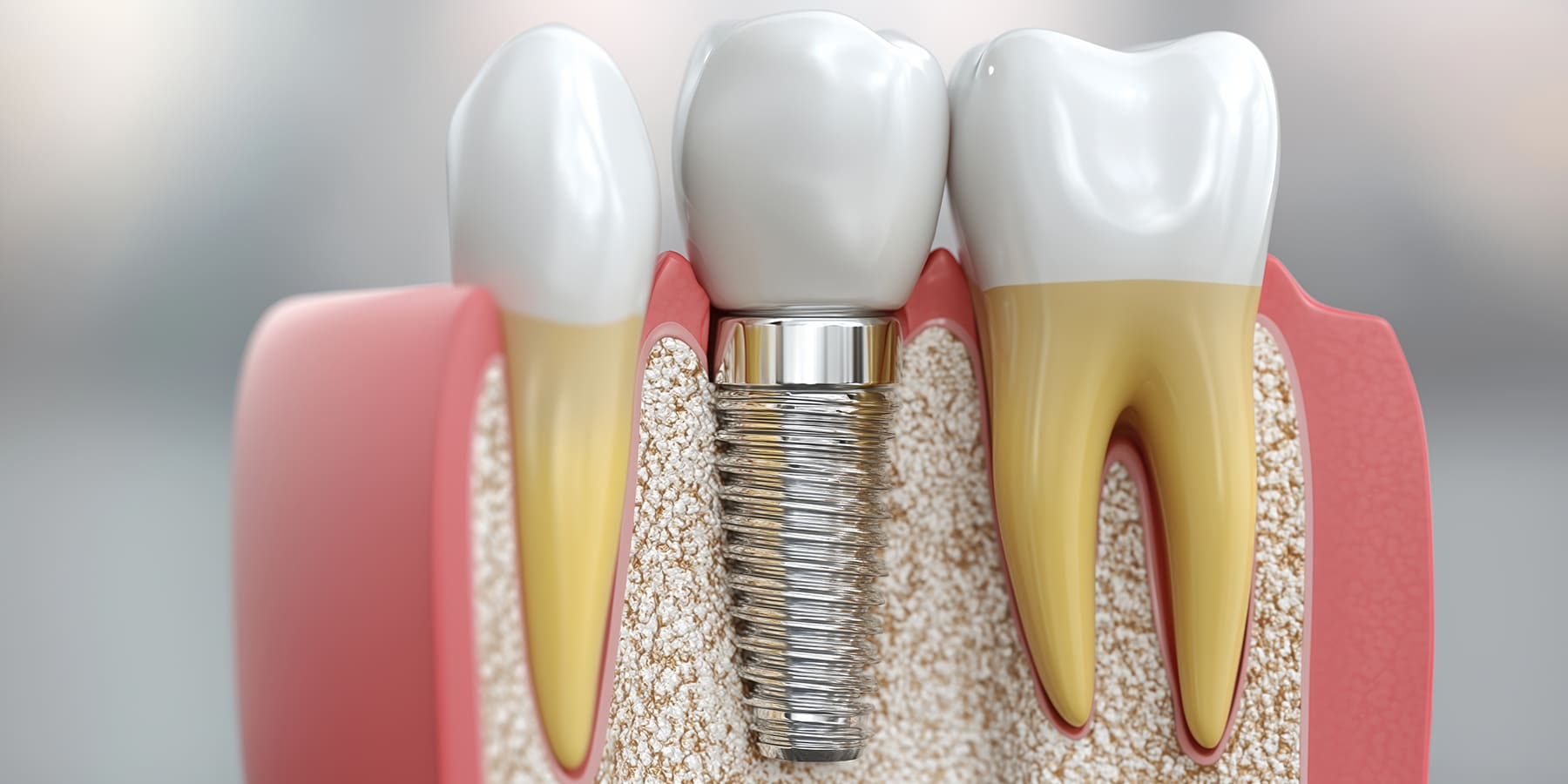 Parts of a Dental Implant: Understanding the Key Components