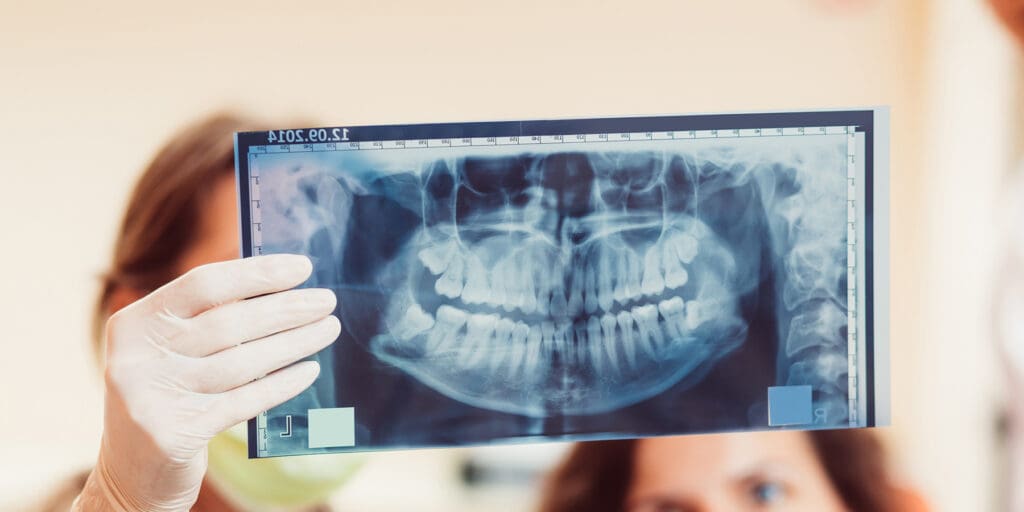 Pros & Cons of Removing Wisdom Teeth: An Oral Surgeons POV