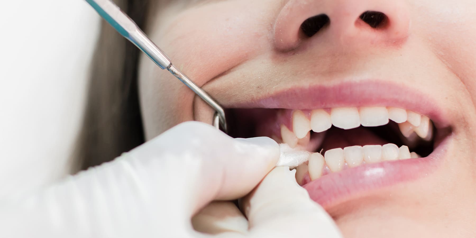 Gauze After Tooth Extraction: How Long To Use It and When To Stop