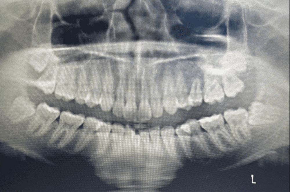 horizontal-impaction