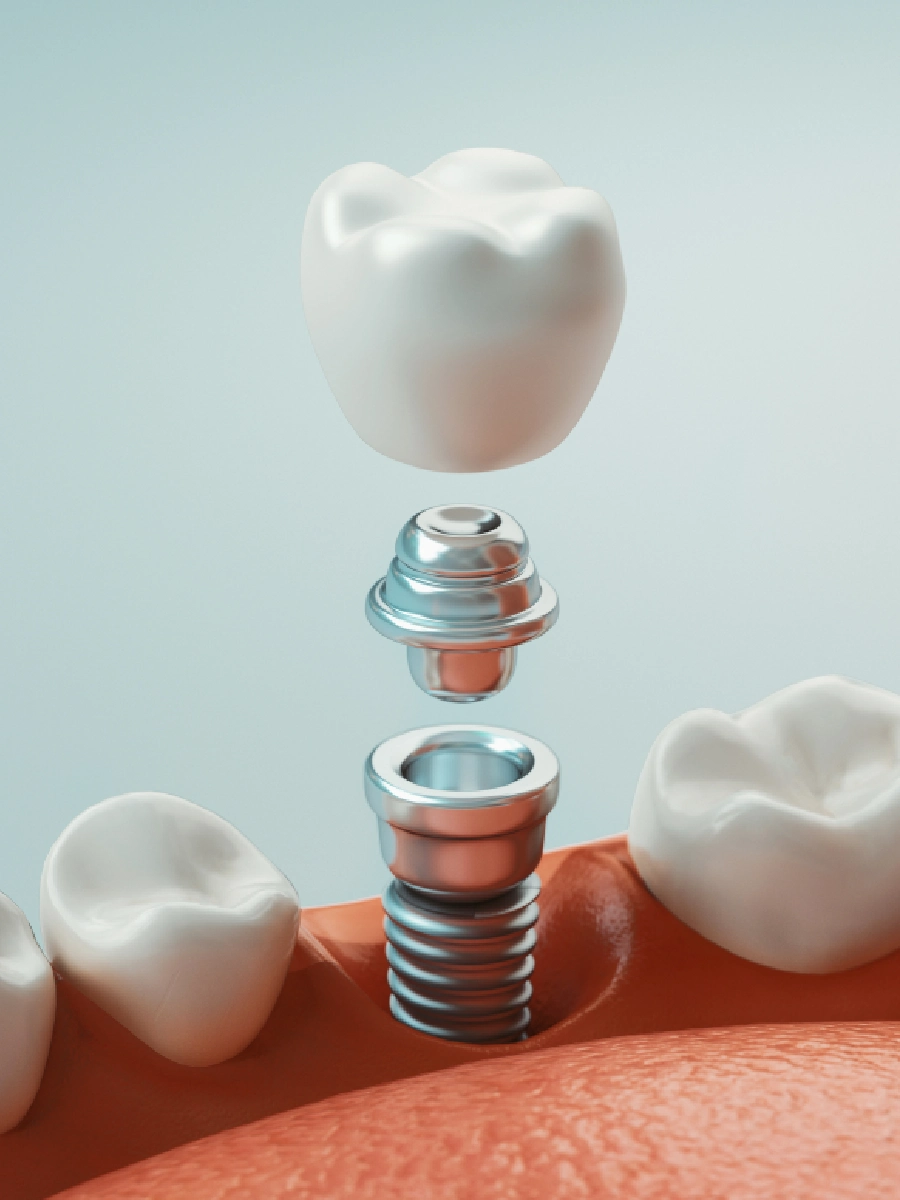 Dental Implants near Markham