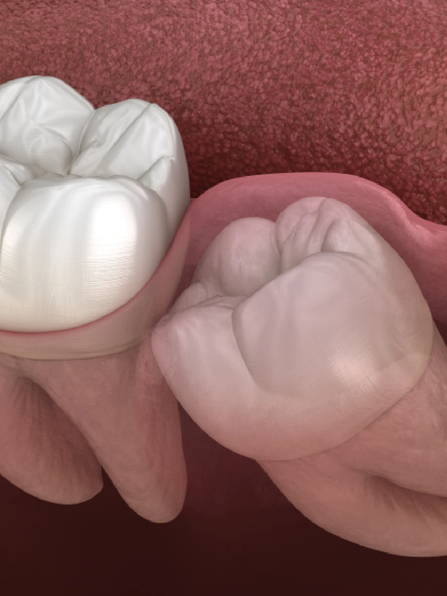 Wisdom Tooth near Markham