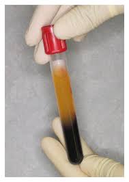 Platelet rich plasma vial