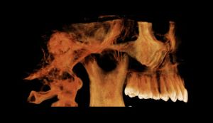 Digital image of upper teeth, side view