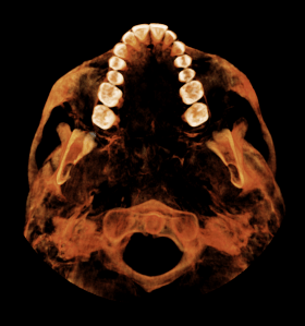 Digital image of upper teeth, bottom view
