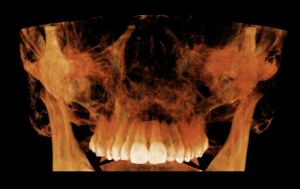 Digital image of upper teeth, front view